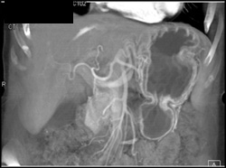 Normal Gastric Folds - CTisus CT Scan