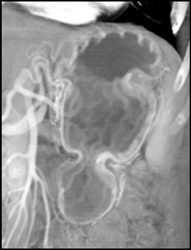 Normal Gastric Folds - CTisus CT Scan