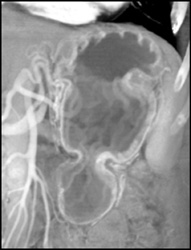 Normal Gastric Folds - CTisus CT Scan