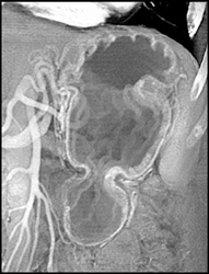 Normal Gastric Folds - CTisus CT Scan