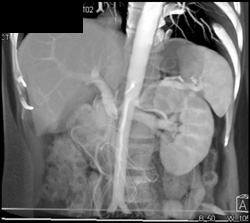 Gastric Cancer - CTisus CT Scan