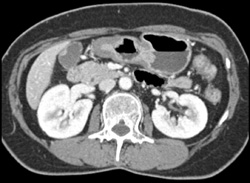 Gastric Cancer - CTisus CT Scan