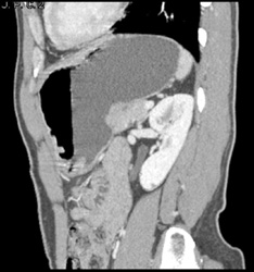 Gastric Cancer - CTisus CT Scan