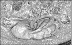 Normal Gastric Folds - CTisus CT Scan