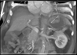 GIST Tumor - CTisus CT Scan