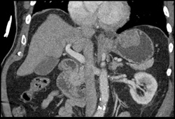 GIST Tumor - CTisus CT Scan