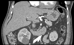 Gastric Tumor (gist) - CTisus CT Scan