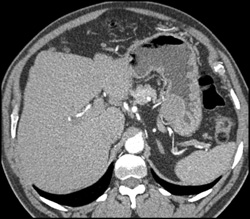 GIST Tumor - CTisus CT Scan