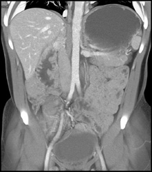 Familial Polyposis With Duodenal Cancer and Gastric Polyps - CTisus CT Scan