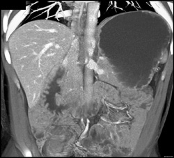 Duodenal Cancer and Gastric Polyps in Polyposis Patient - CTisus CT Scan