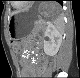 GIST Tumor - CTisus CT Scan