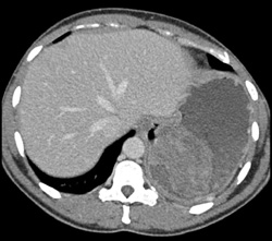 GIST Tumor - CTisus CT Scan