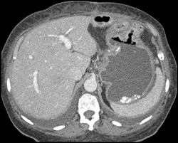 Gastric Cancer - CTisus CT Scan