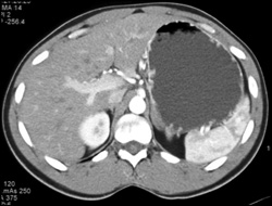 Subtle Gastric Polyps in A Patient With Familial Polyposis - CTisus CT Scan