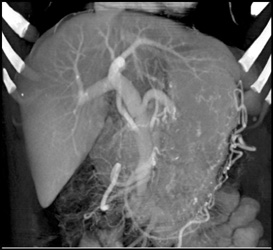 Venous Collaterals Around Stomach - CTisus CT Scan