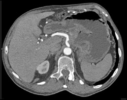 Ulcerating Gastric Mass - CTisus CT Scan