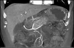 Gastric Tumor Invades the Pancreas - CTisus CT Scan