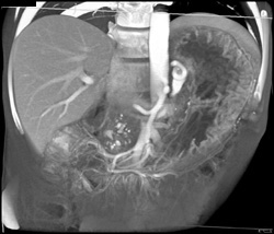 3D Gastric Folds - CTisus CT Scan