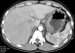 Metastatic Gastric Cancer (breast Primary) - CTisus CT Scan