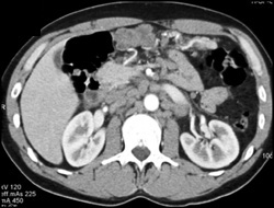 Implants on Omentum and Adenopathy - CTisus CT Scan