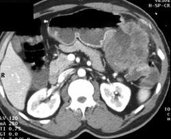 Colon Cancer Invades the Stomach - CTisus CT Scan