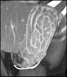 Gastrinoma With Thick Folds (see Next Few Cases) - CTisus CT Scan