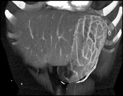 Thickened Folds - CTisus CT Scan