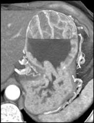 Gastrinoma and Thick Gastric Folds - CTisus CT Scan