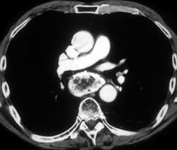 Achalasia Without Abscess - CTisus CT Scan