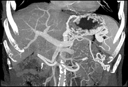 Gastric Varices - CTisus CT Scan