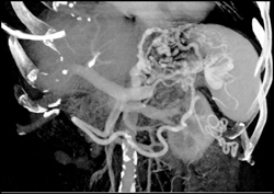 Gastric Varices - CTisus CT Scan