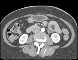 Gist in Antrum - CTisus CT Scan