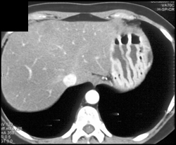 Thick Gastric Folds Due to Gastrinoma - CTisus CT Scan