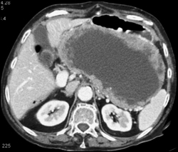 Gist of Stomach - CTisus CT Scan