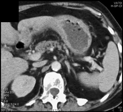 Metastatic Breast Cancer to Stomach - CTisus CT Scan