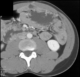 Gastric Polyps in Familial Polyposis Syndrome - CTisus CT Scan