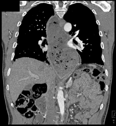 Gastric Pull Up - CTisus CT Scan