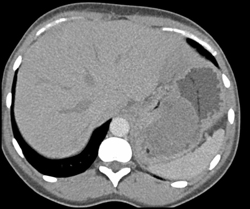 GIST Tumor - CTisus CT Scan