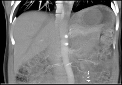 GIST Tumor - CTisus CT Scan