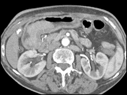 Gastric Adenocarcinoma With Bleed - CTisus CT Scan