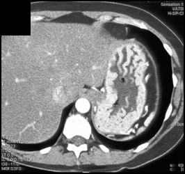 Gastritis - CTisus CT Scan