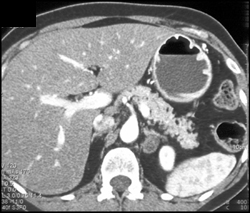 Gastritis - CTisus CT Scan