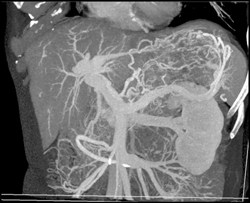 Gastritis - CTisus CT Scan