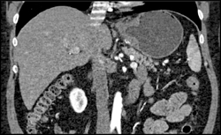 Gastric Cancer - CTisus CT Scan