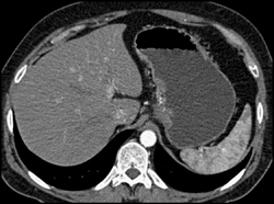 Gastric Cancer - CTisus CT Scan