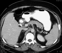 Antral Gastritis Due to NSAIDS - CTisus CT Scan