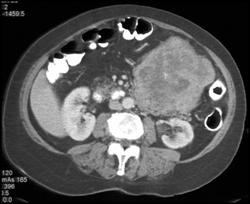 GIST Tumor - CTisus CT Scan