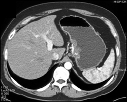 Gastric Adenocarcinoma - CTisus CT Scan