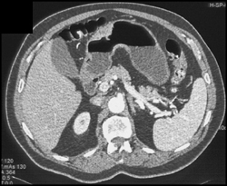 Gastric Adenocarcinoma - CTisus CT Scan