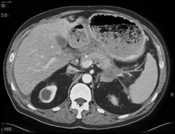 Carcinomatosis Involves Mesentery - CTisus CT Scan